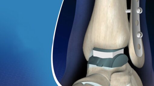 Ankle Replacement Surgery Procedure, Post Measures and Projections