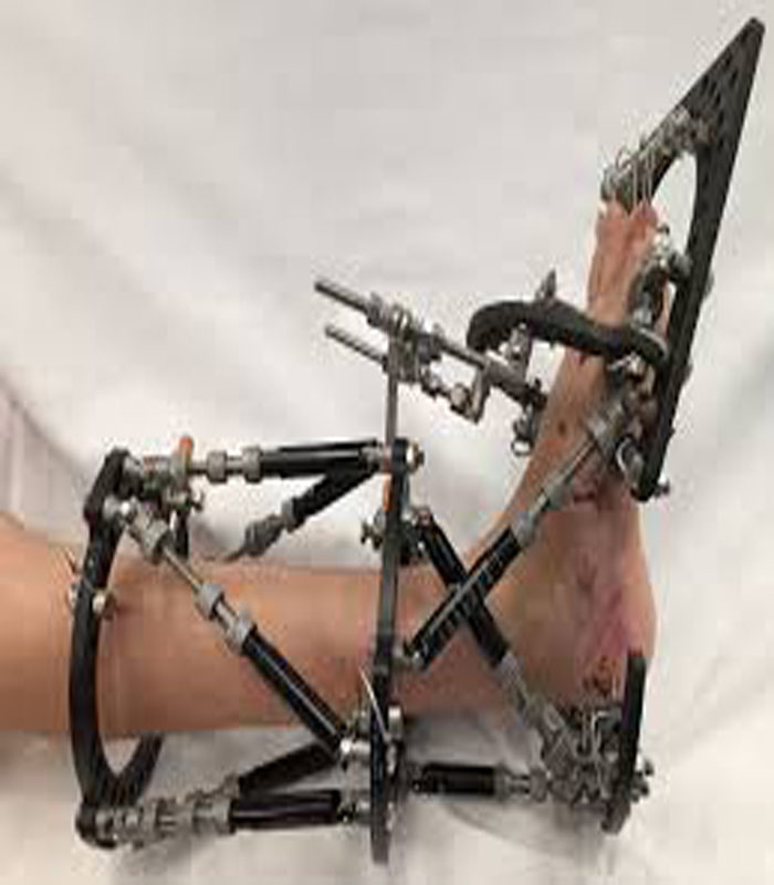 Orthopedic Implants & Instruments Manufacturer/Suppliers- Uteshiya