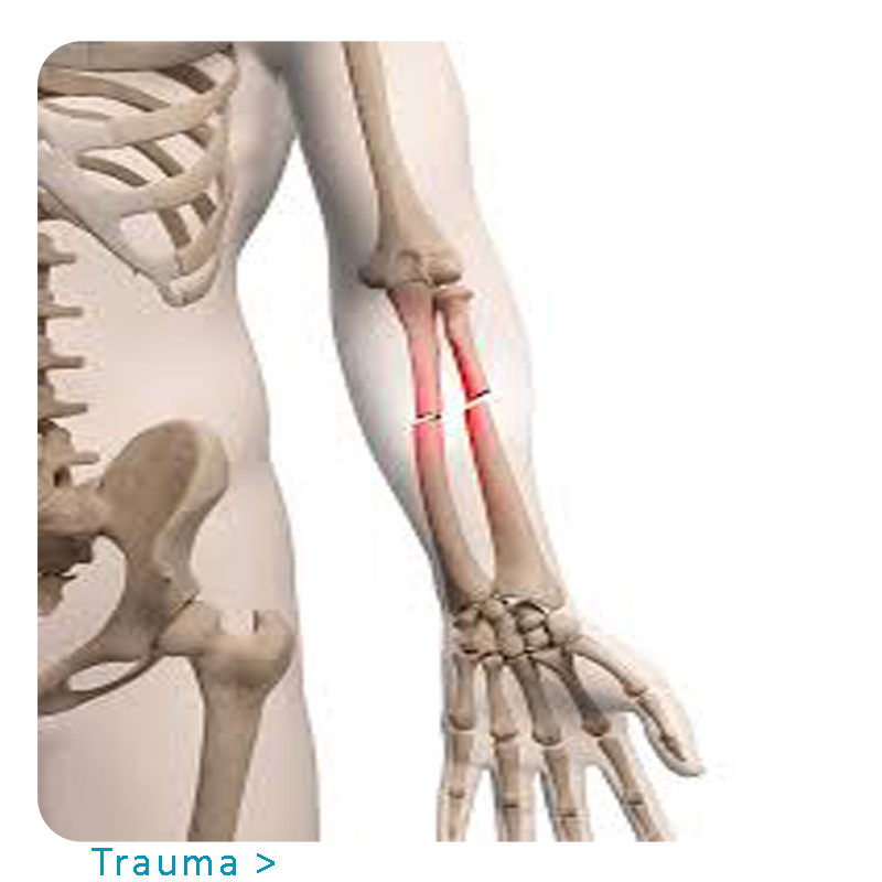 Orthopedic Implants & Instruments Manufacturer/Suppliers- Uteshiya