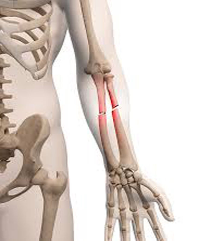 Orthopedic Implants & Instruments Manufacturer/Suppliers- Uteshiya
