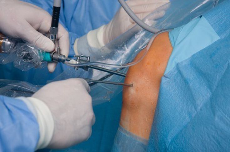 Knee Arthroscopy Surgery | Common Causes and Benefits