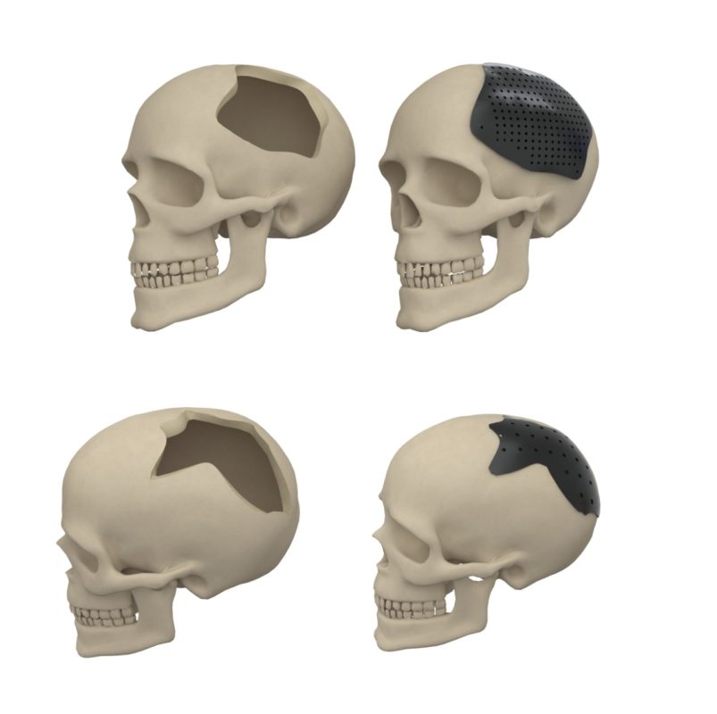 Orthopedic Implants & Instruments Manufacturer/Suppliers- Uteshiya