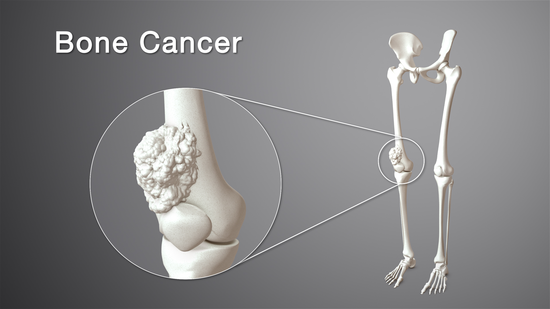 Not all bone tumors are cancerous