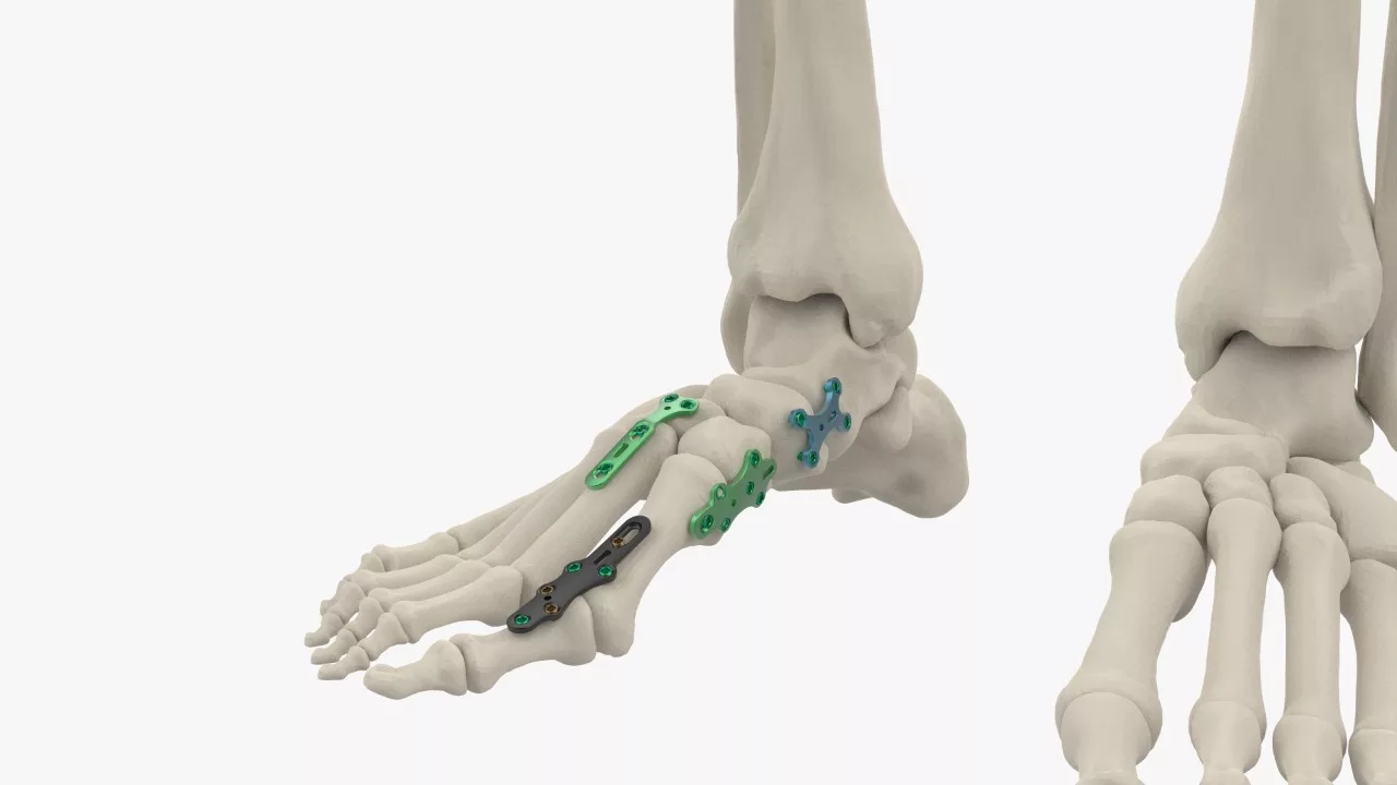 Orthopedic Implants & Instruments Manufacturer/Suppliers- Uteshiya