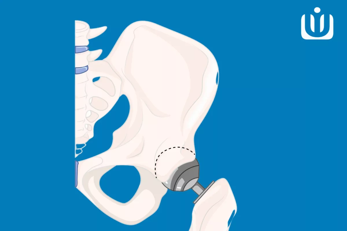 Orthopedic Implants & Instruments Manufacturer/Suppliers- Uteshiya