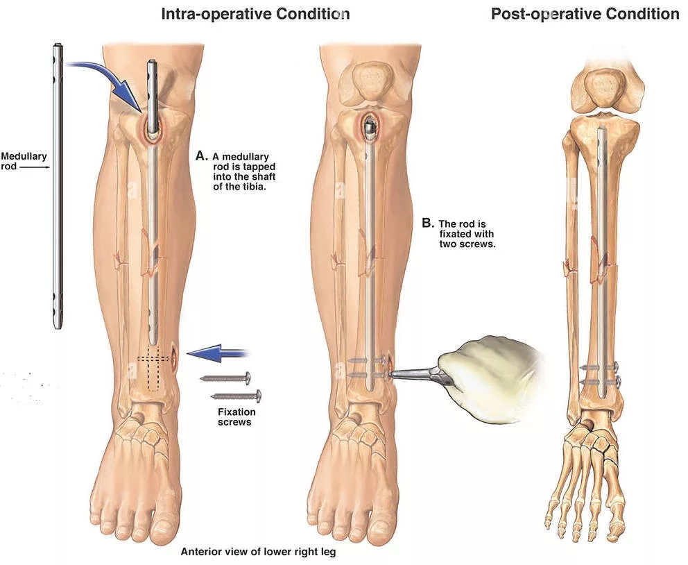 From Diagnosis to Healing An Expert Guide to Tibia Fractures and Successful Recovery