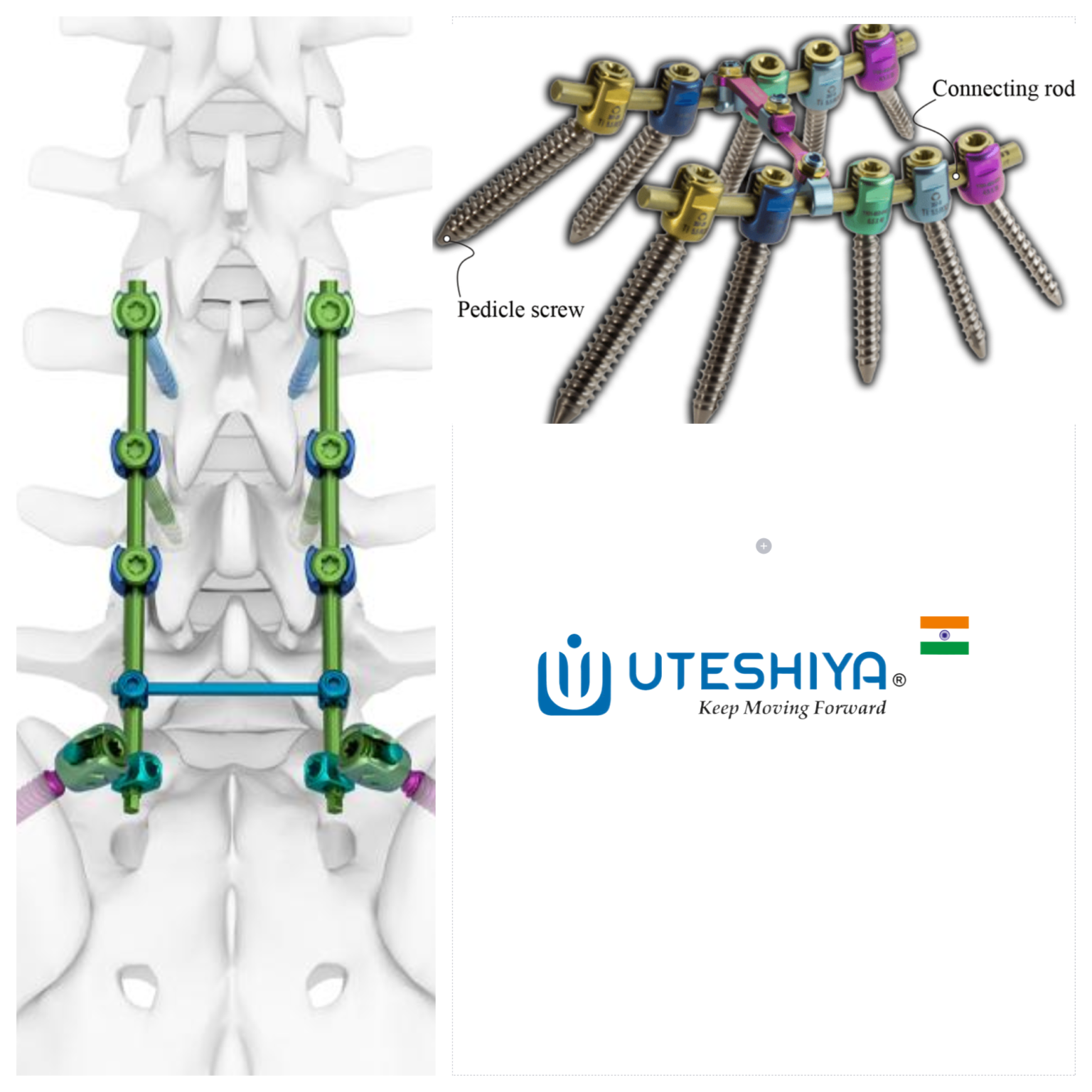 Enhancing Spinal Stability_ A Comprehensive Guide to Pedicle Screw Systems