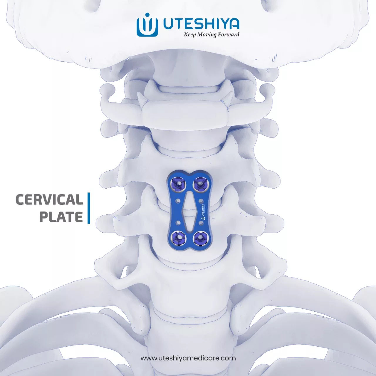 Cervical Plate: Advancements in Spinal Surgery for Neck Stability Cervical Plate: Advancements in Spinal Surgery for Neck Stability Cervical Plate: Advancements in Spinal Surgery for Neck Stability
