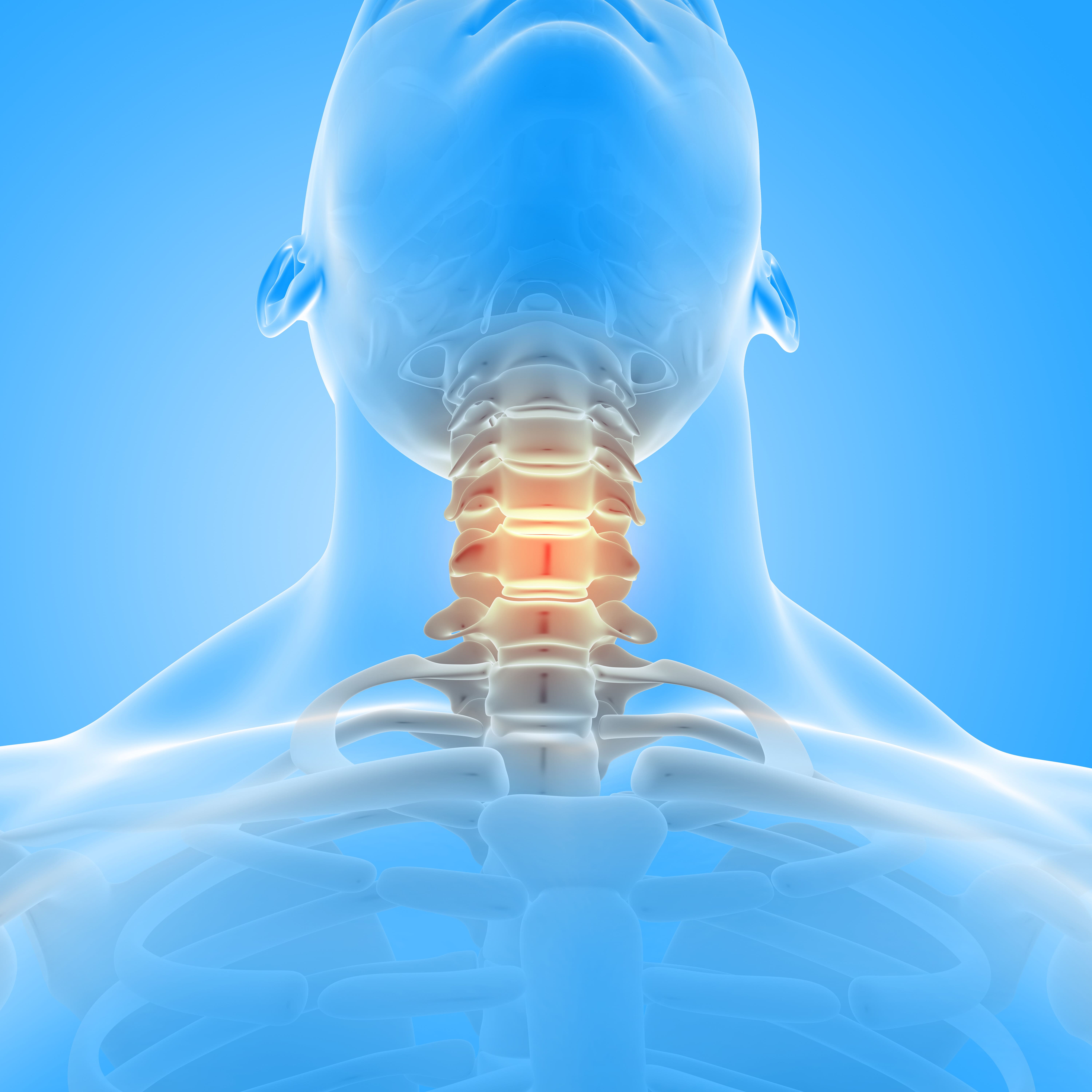 Living with a Cervical Cage Tips for a Healthy and Active Lifestyle