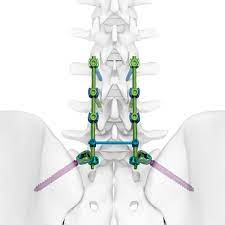 Invisible Strength: The Significance of Connectors in Spinal Surgery