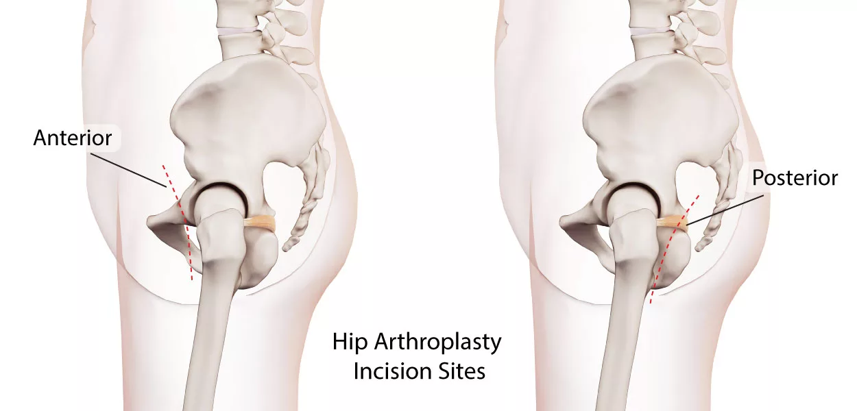 Anterior Hip Replacement Surgery Procedure And Its Advantages