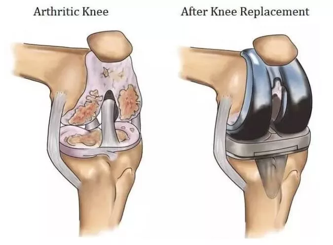 A Journey of Transformation: Before and After Total Knee Replacement Surgery