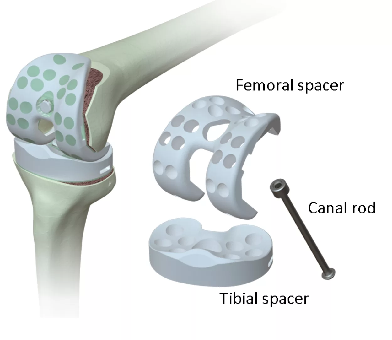 Knee-Transformation-A-Comprehensive-Guide-to-Total-Knee-Replacement-Surgery