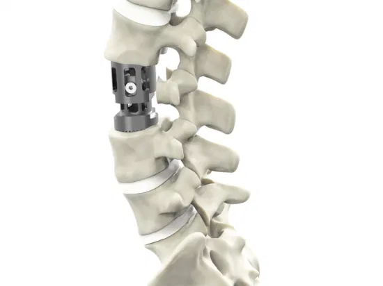 Structural Marvels Advancing Spinal Health with Expandable Cages