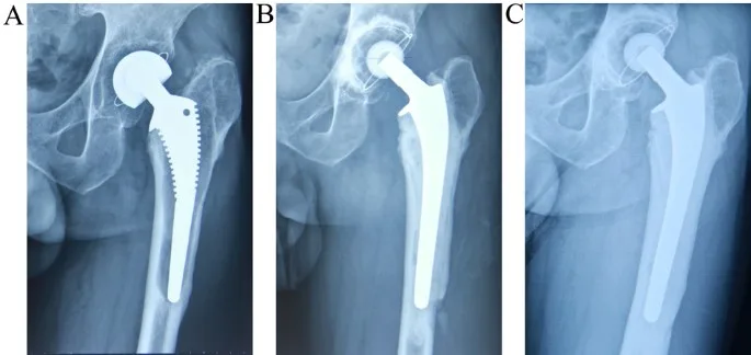 Understanding Modular Cemented Stems in Orthopedic Surgery