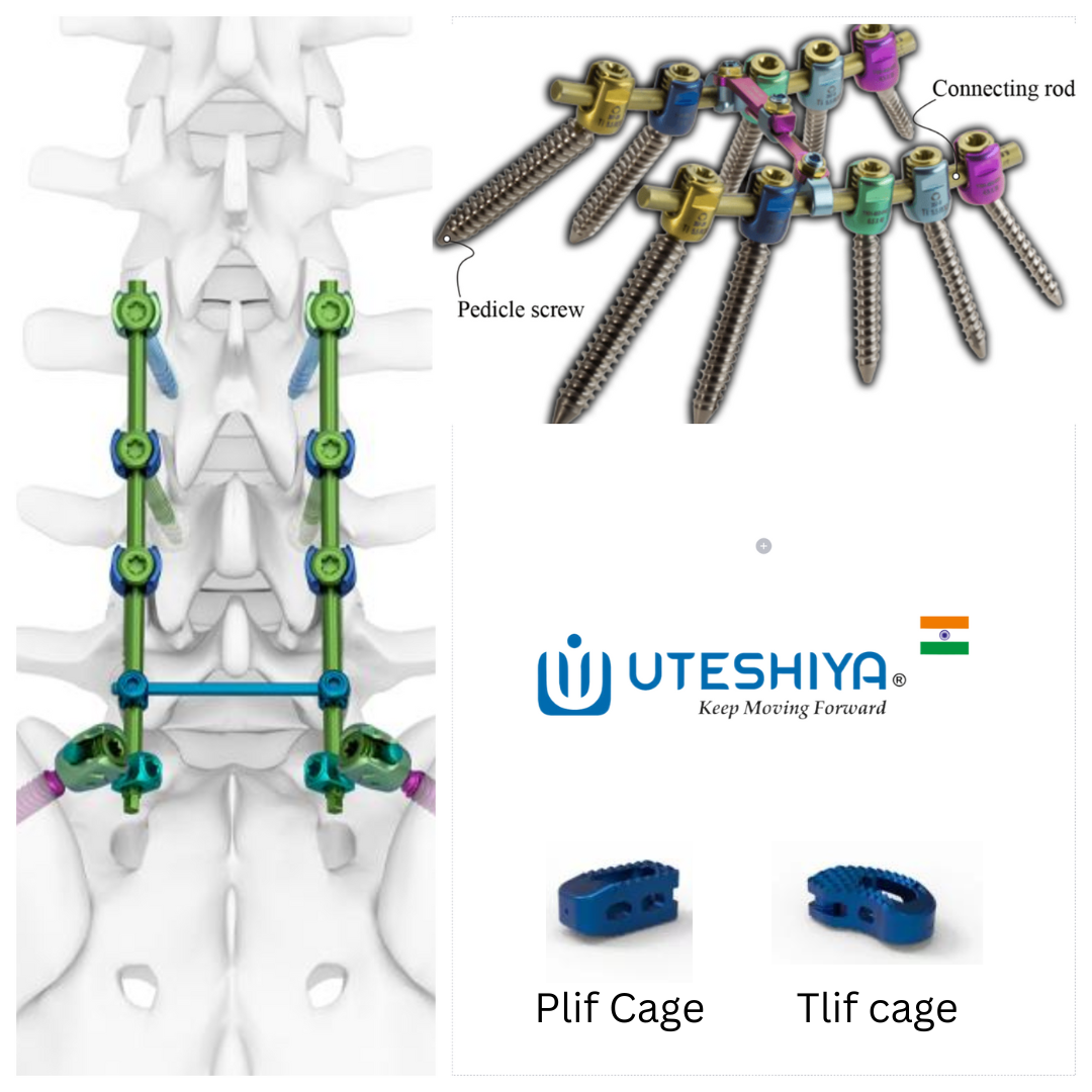 Revolutionizing Spinal Surgery The Impact of Spinal Implants