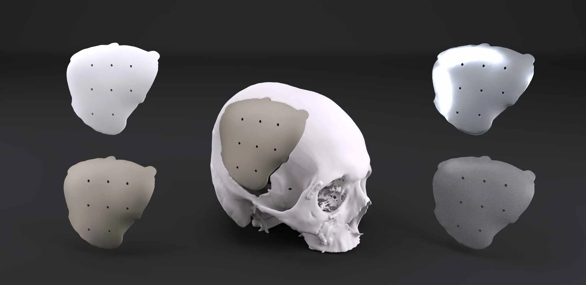 Analysis of PMMA 3DP Implants Aesthetics and Strengths