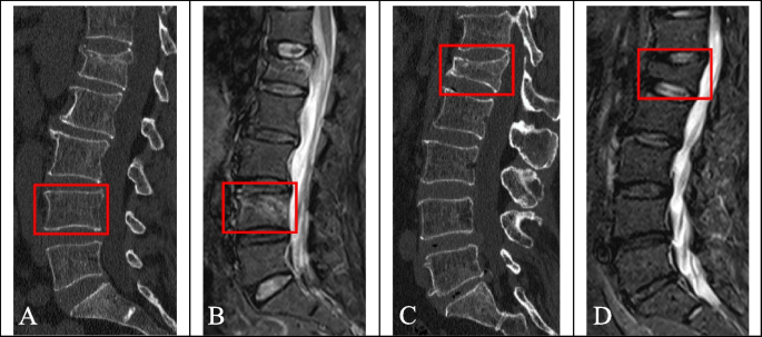 Spinal Compression Fractures A Comprehensive Overview