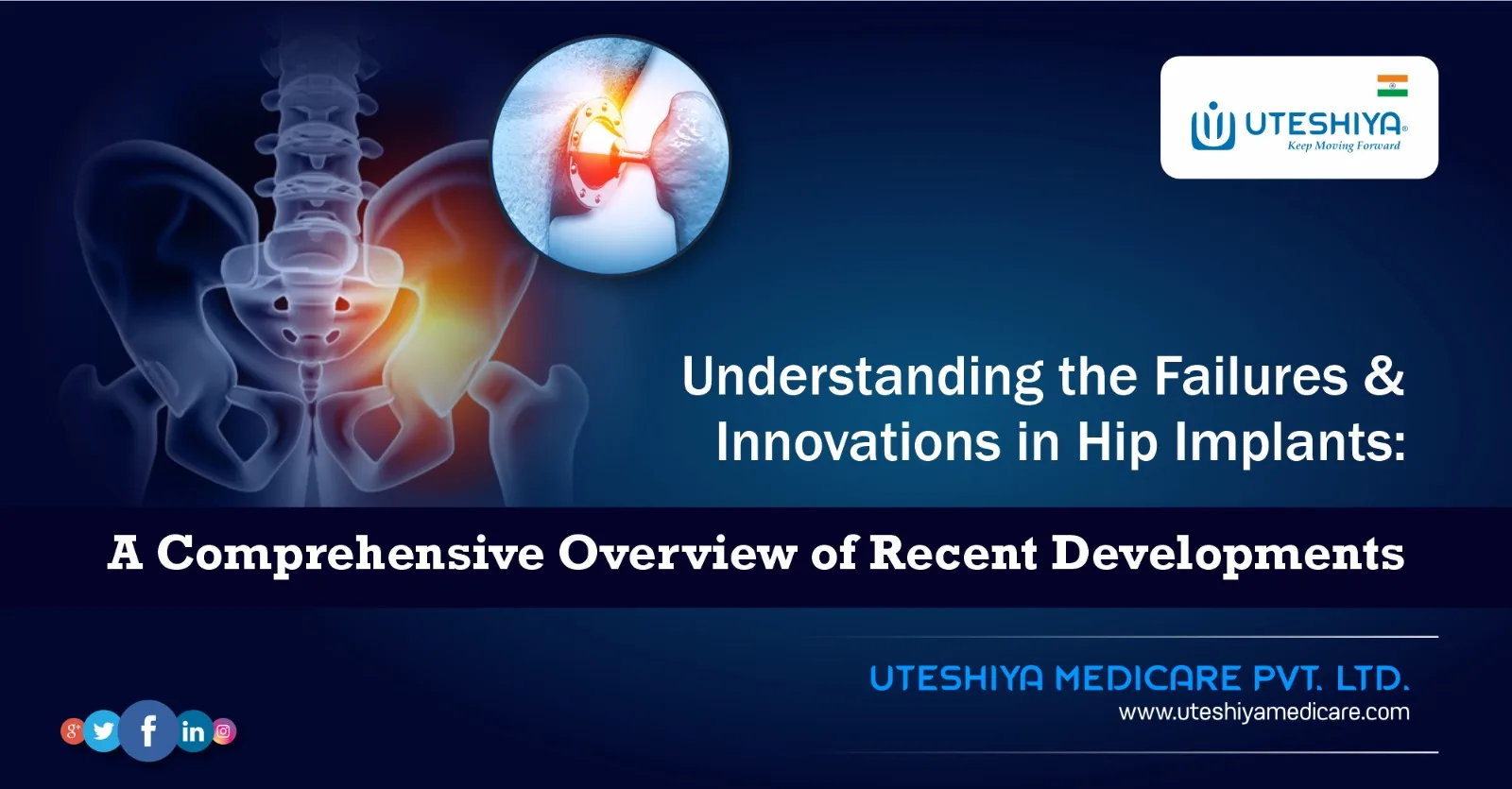 Understanding the Failures and Innovations in Hip Implants A Comprehensive Overview of Recent Developments