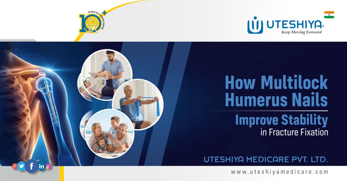 How Multilock Humerus Nails Improve Stability in Fracture Fixation